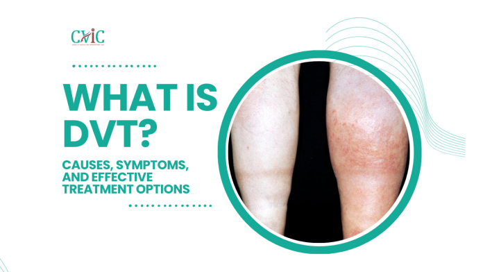 what is DVT