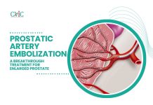 Prostatic Artery Embolization: A Breakthrough Treatment for Enlarged Prostate