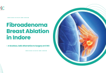 Fibroadenoma Breast Ablation in Indore – A Scarless, Safe Alternative to Surgery at CVIC Fibroadenoma Breast Ablation
