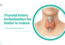 Thyroid Artery Embolization for Goiter in Indore – A Non-Surgical Breakthrough by CVIC Thyroid Artery Embolization for Goiter