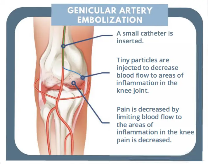 Knee Pain Embolization in Indore
