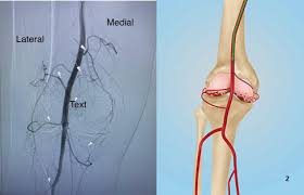 Knee Pain Embolization in Indore