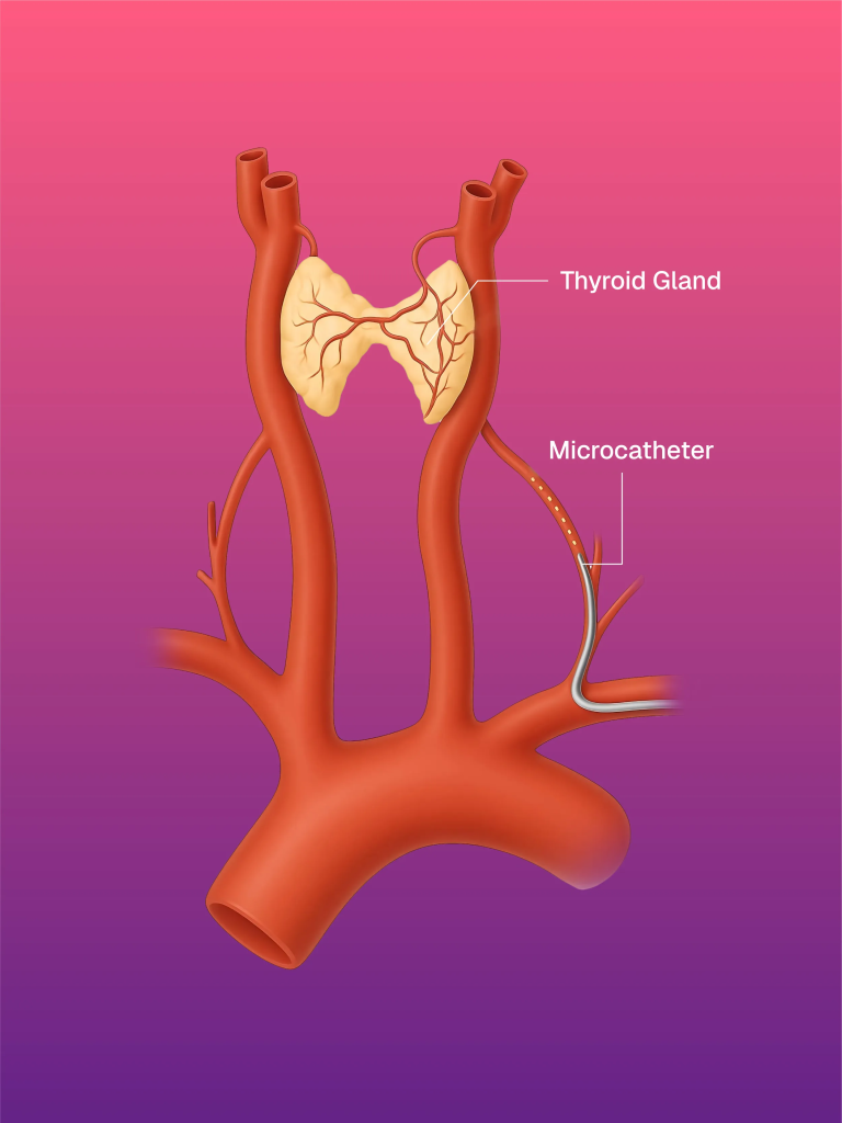 Thyroid Artery Embolization for Goiter