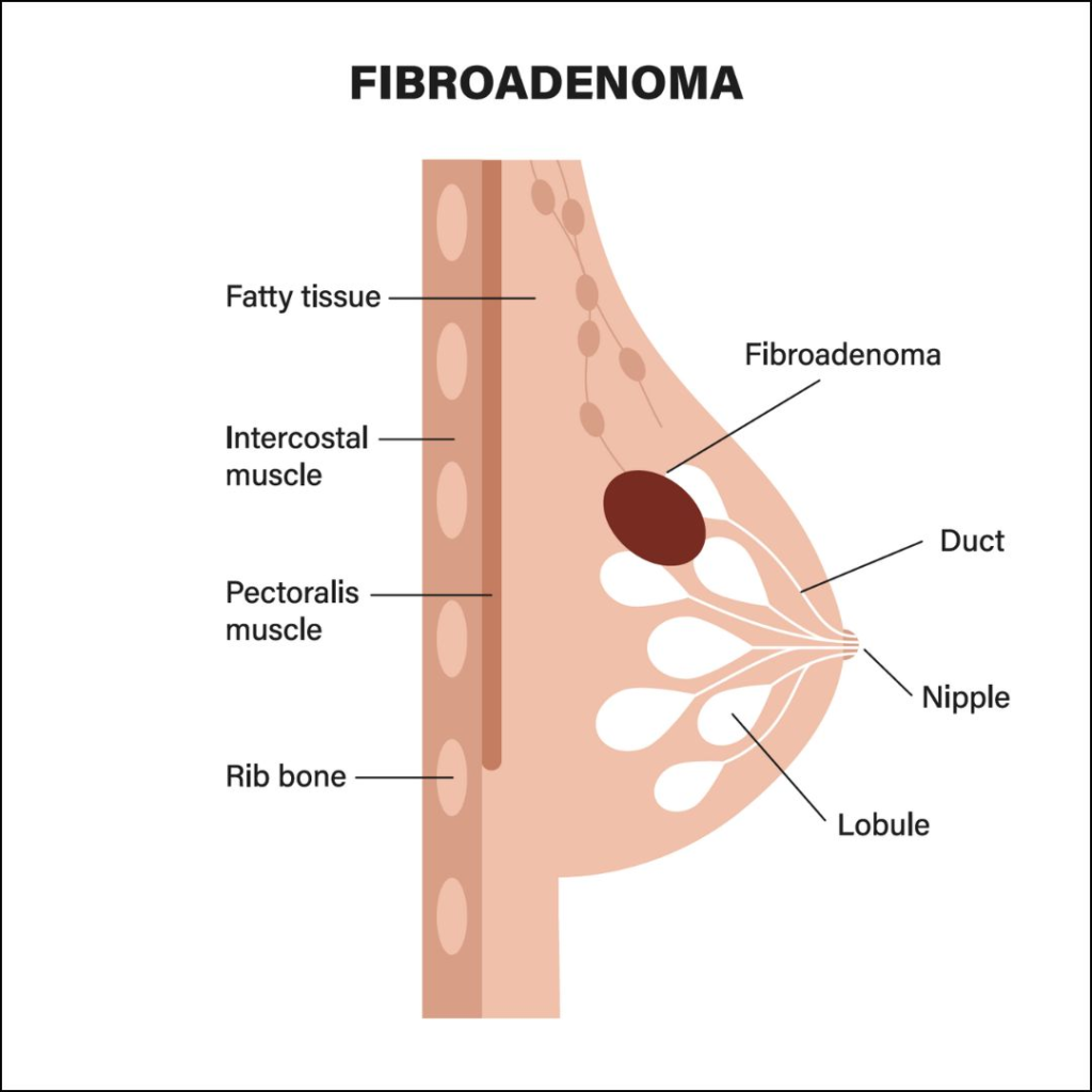 Fibroadenoma Breast Ablation