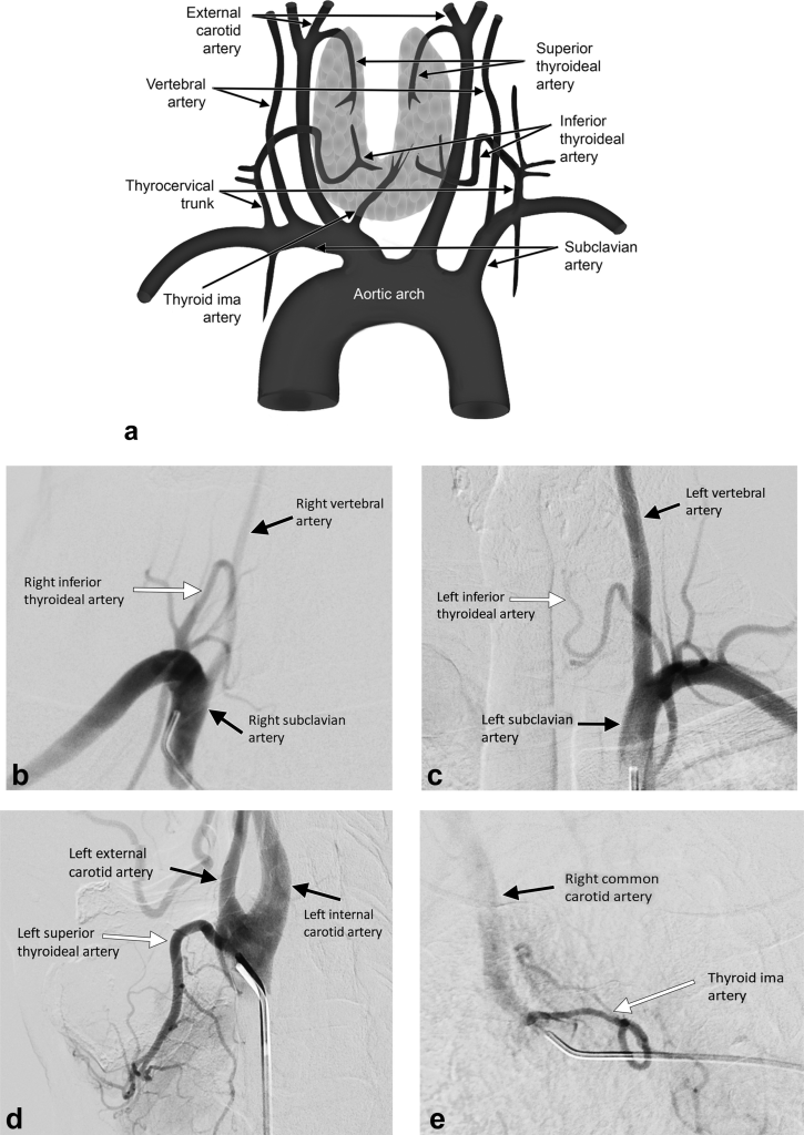 Thyroid Artery Embolization for Goiter