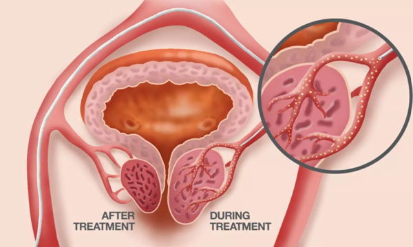 Prostate Artery Embolization in Indore
