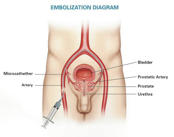 Prostate Artery Embolization in Indore