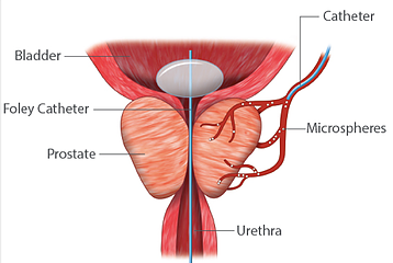 Prostate Artery Embolization in Indore