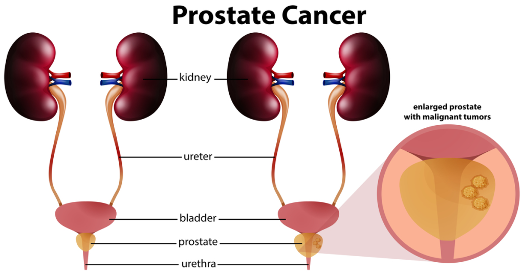 Non-Surgical Prostate Treatment in Indore