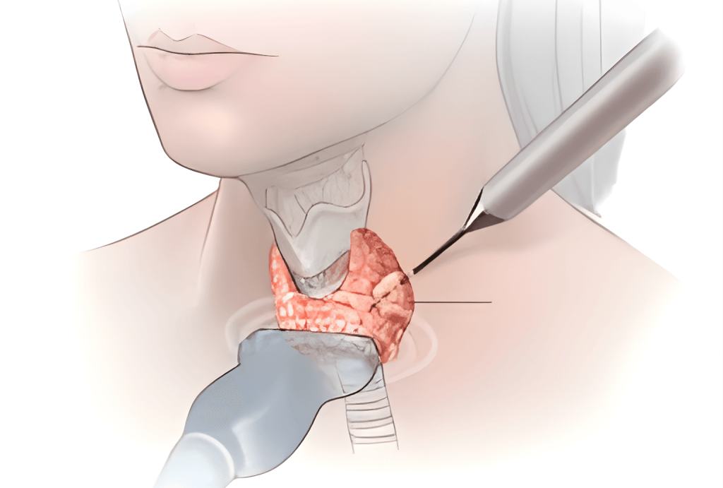 Scarless Thyroid Procedure Indore