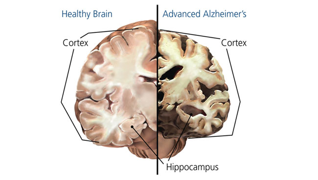 Alzheimer’s Disease