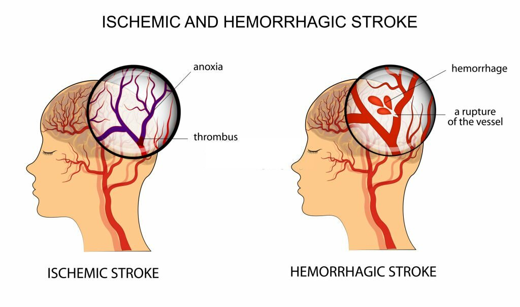 What Happens During a Brain Stroke