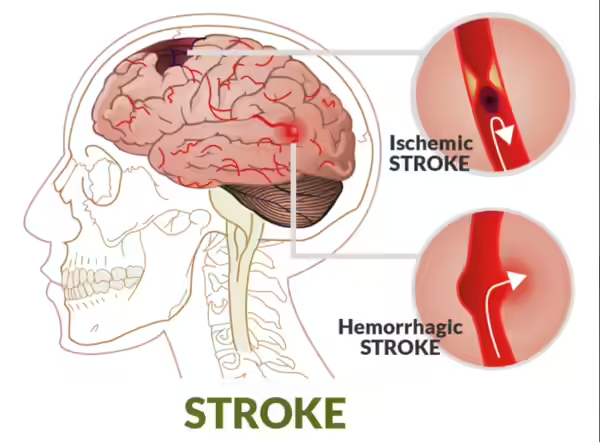 What Happens During a Brain Stroke