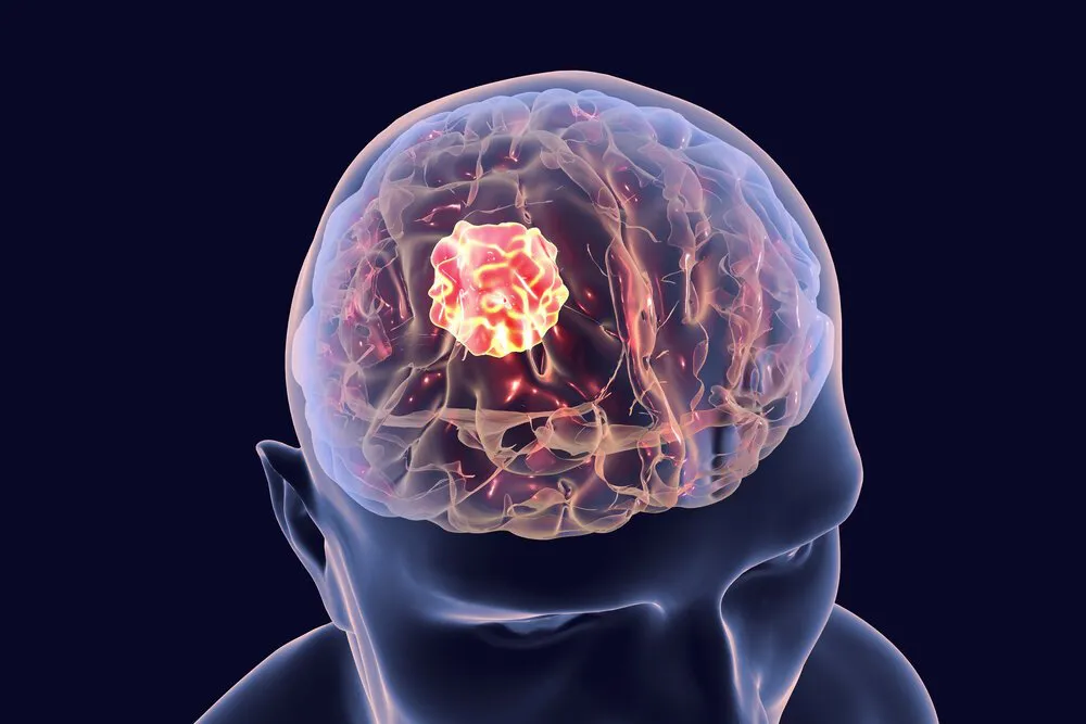 Symptoms of Brain Tumor