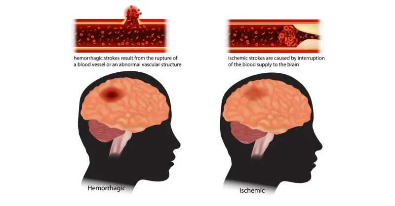 What Happens During a Brain Stroke
