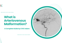 What is Arteriovenous Malformation? A Complete Guide by CVIC Indore Arteriovenous Malformation