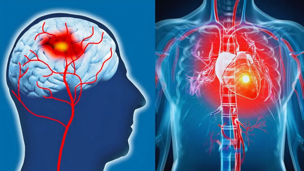 Stroke vs Heart Attack