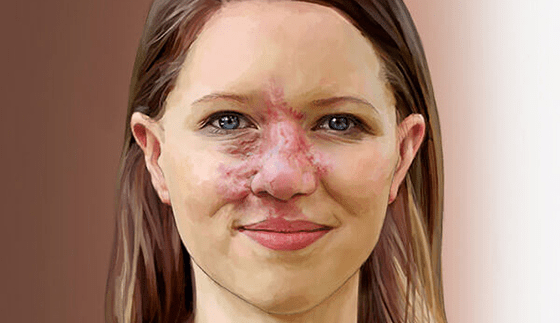 Arteriovenous Malformation