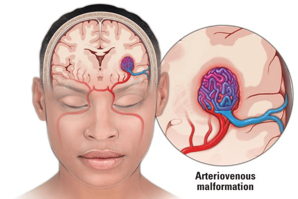 Arteriovenous Malformation