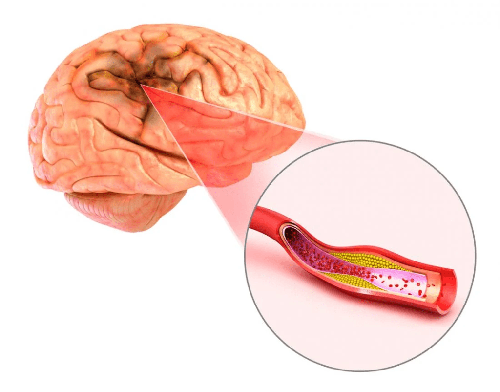 Brain Aneurysm