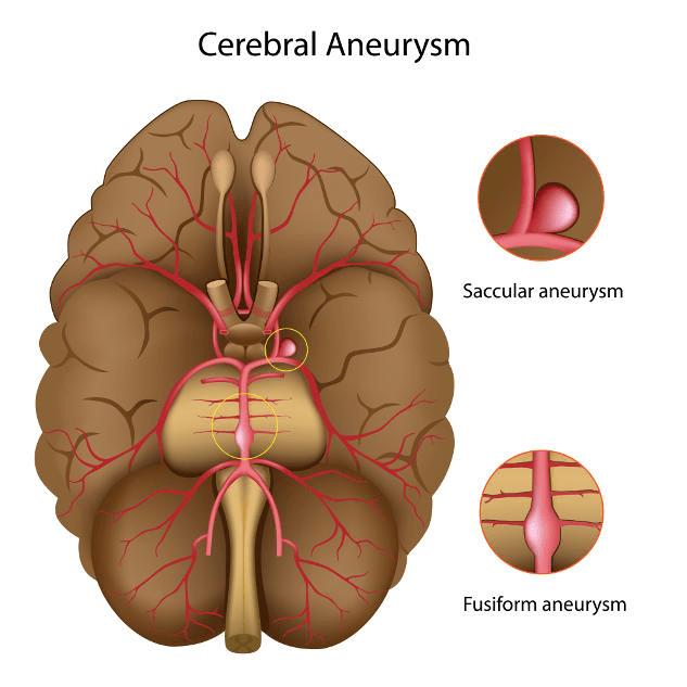 Brain Aneurysm