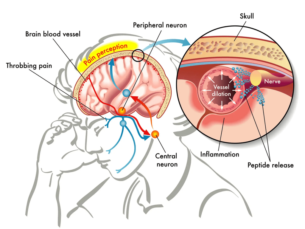Chronic Headache Causes in Brain