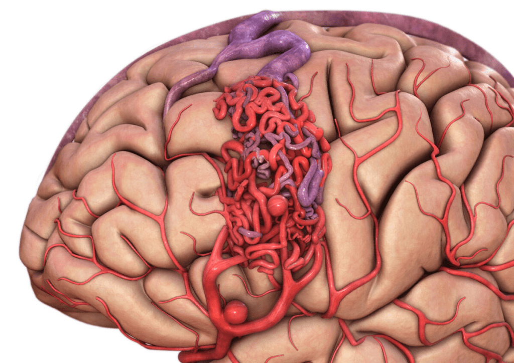 Arteriovenous Malformation