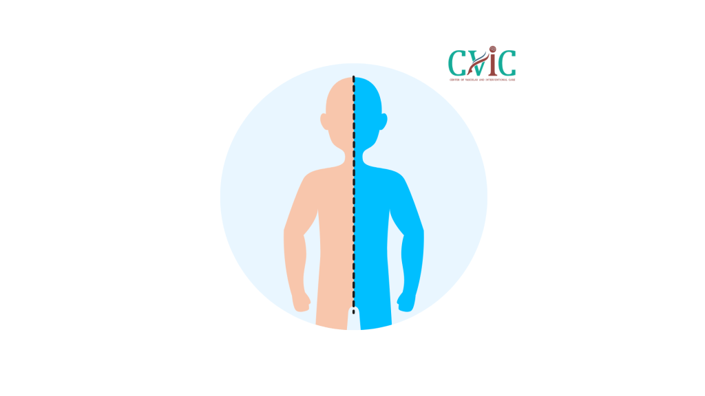 Causes of One-Side Body Weakness