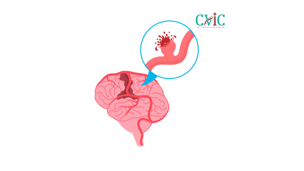 Symptoms Before Brain Aneurysm Rupture