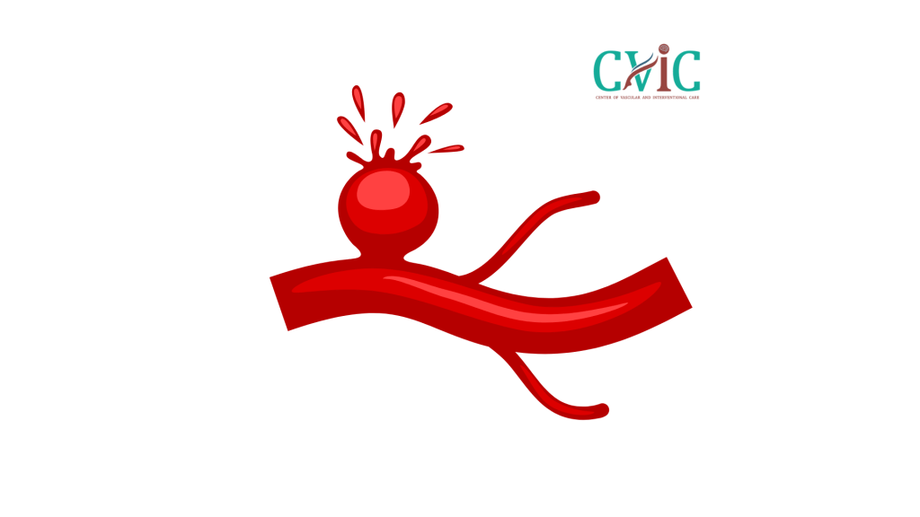 Symptoms Before Brain Aneurysm Rupture
