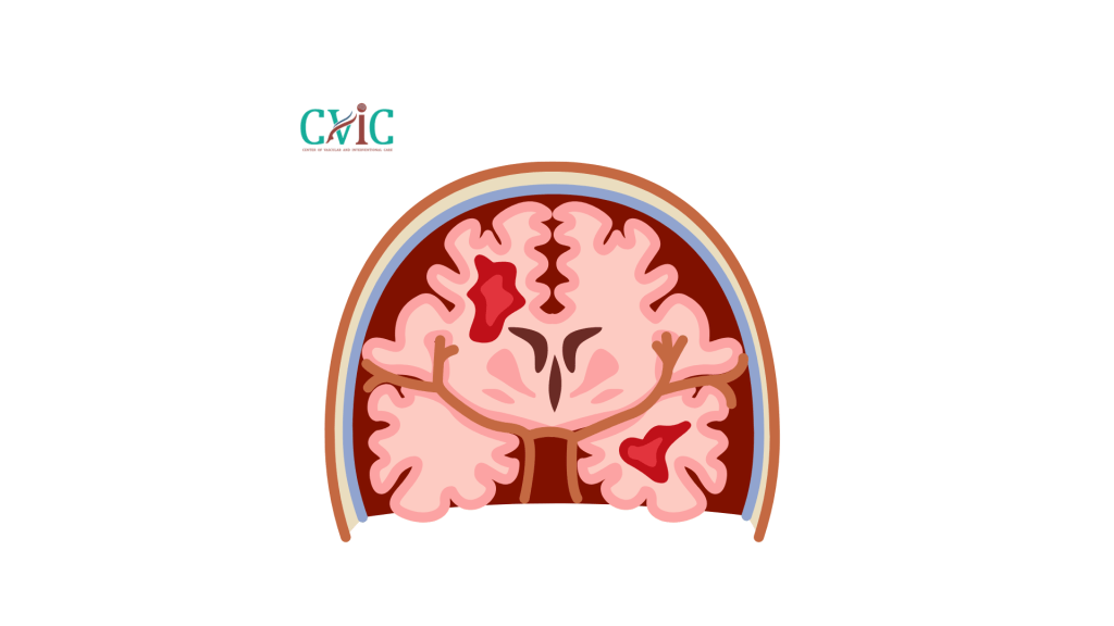 Can Brain Tumor Be Treated Without Surgery? A Complete Guide to Non-Surgical Options