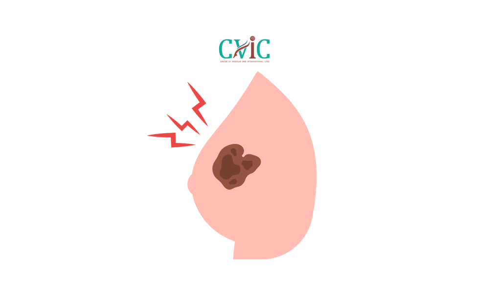 What Patients Need to Know Before a Breast Biopsy with the Encor Enspire System