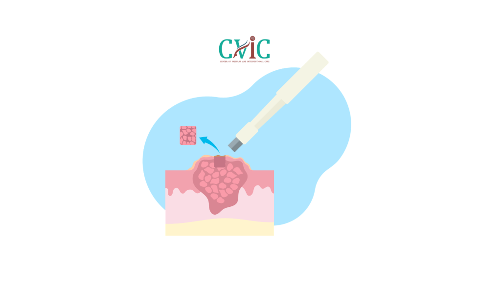 Vacuum-Assisted Breast Biopsy vs Core Needle Biopsy: 5 Reasons to Choose Encor Enspire