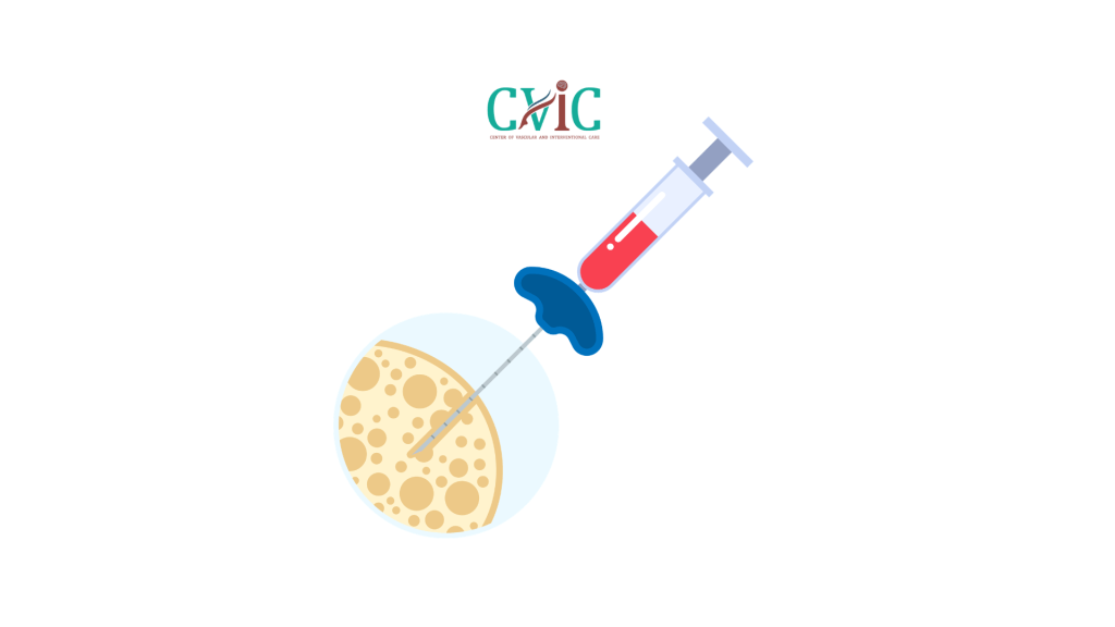 Vacuum-Assisted Breast Biopsy vs Core Needle Biopsy: 5 Reasons to Choose Encor Enspire