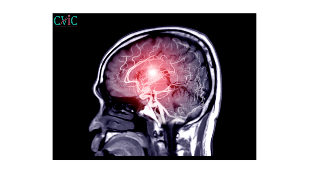 Which surgery is best for brain aneurysm – Endovascular coiling vs surgical clipping treatment at CVIC Indore by Dr. Alok K Udiya, Dr. Shailesh Gupta, and Dr. Nishant Bhargava near Gita Bhawan Indore