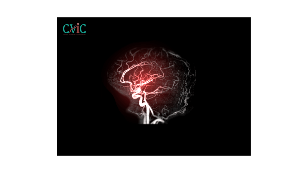 Which surgery is best for brain aneurysm – Endovascular coiling vs surgical clipping treatment at CVIC Indore by Dr. Alok K Udiya, Dr. Shailesh Gupta, and Dr. Nishant Bhargava near Gita Bhawan Indore