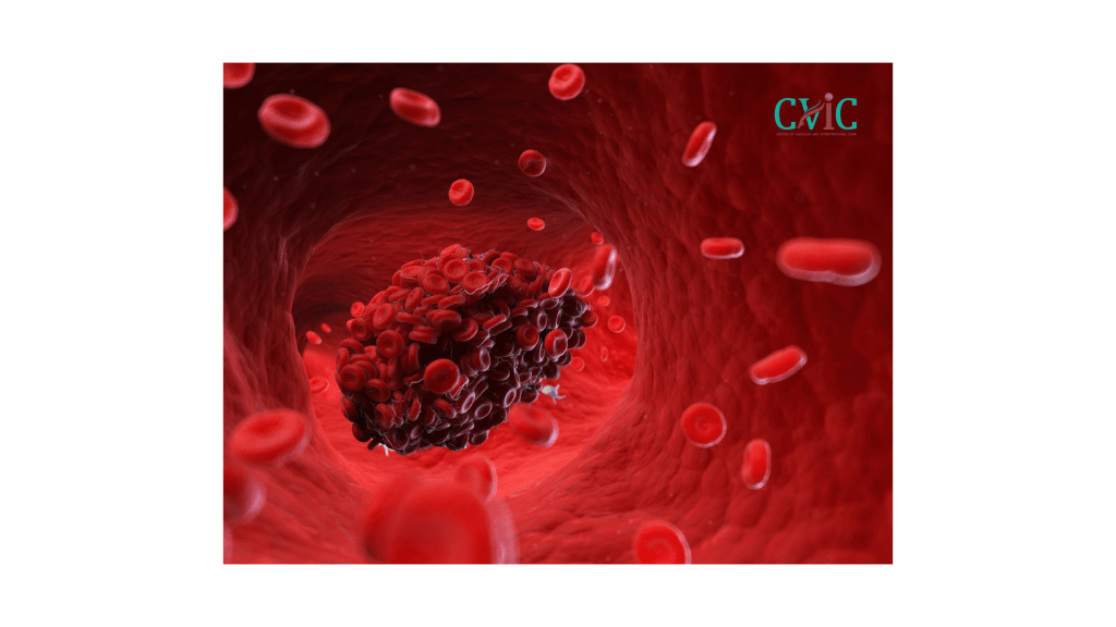 Causes of brain blood clots explained by neurovascular specialists at CVIC Indore near Gita Bhawan Indore