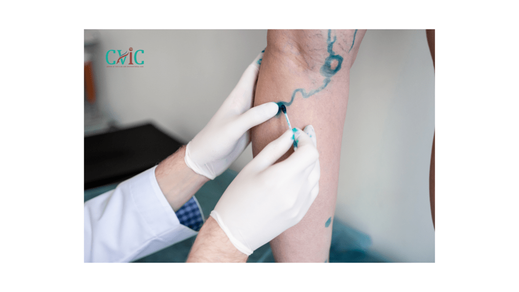 Vascular Surgeon in Indore providing advanced artery and vein treatment at CVIC Indore by Dr. Alok K Udiya, Dr. Shailesh Gupta, and Dr. Nishant Bhargava near Gita Bhawan Indore