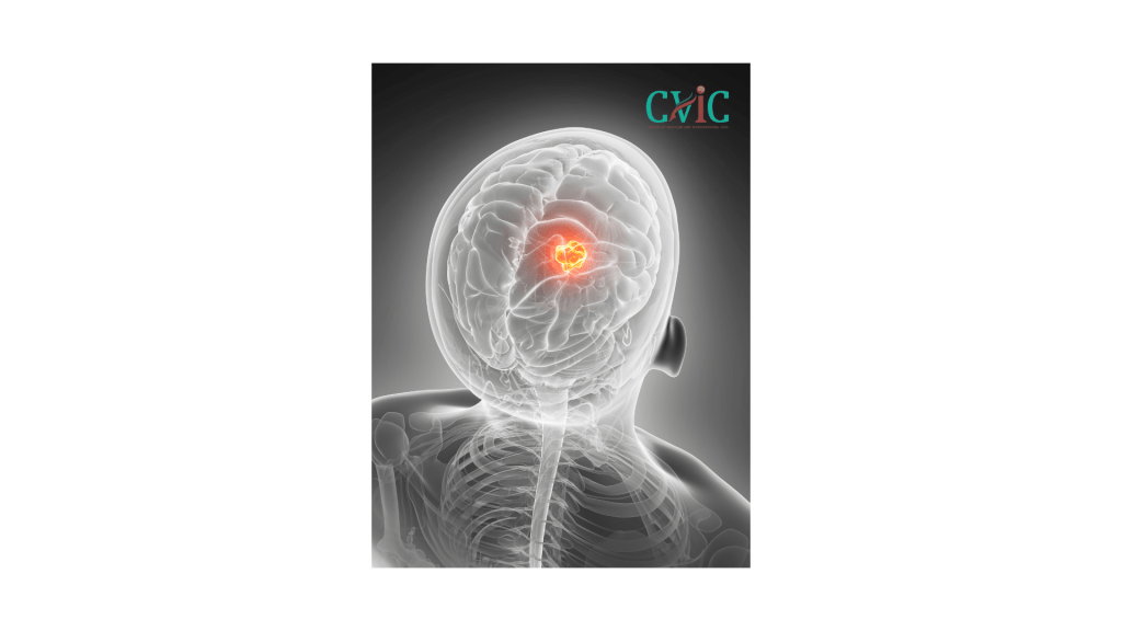 Brain tumor diagnosis and advanced treatment at CVIC Indore by Dr. Alok K Udiya, Dr. Shailesh Gupta, and Dr. Nishant Bhargava near Gita Bhawan Indore