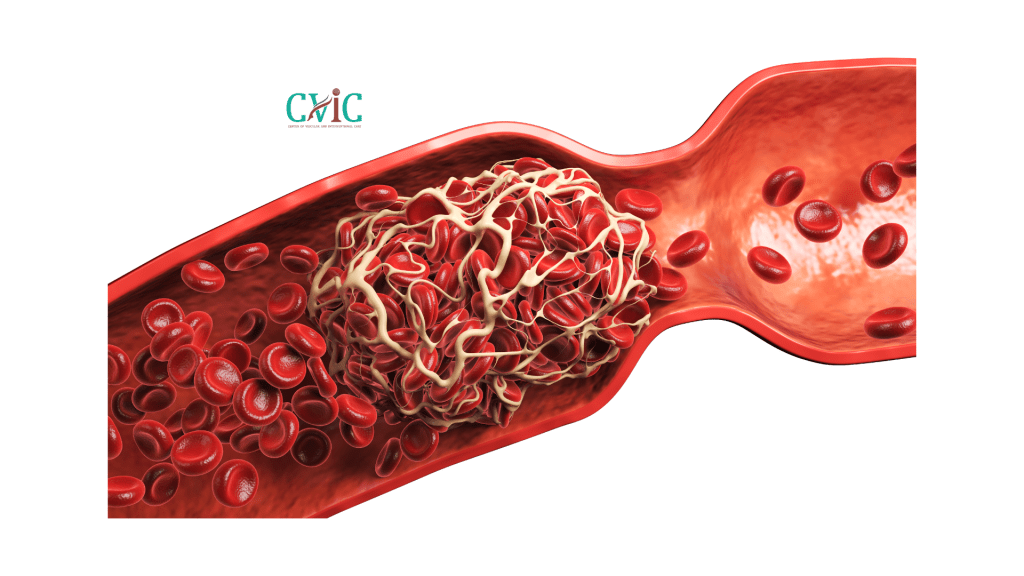 Causes of brain blood clots explained by neurovascular specialists at CVIC Indore near Gita Bhawan Indore
