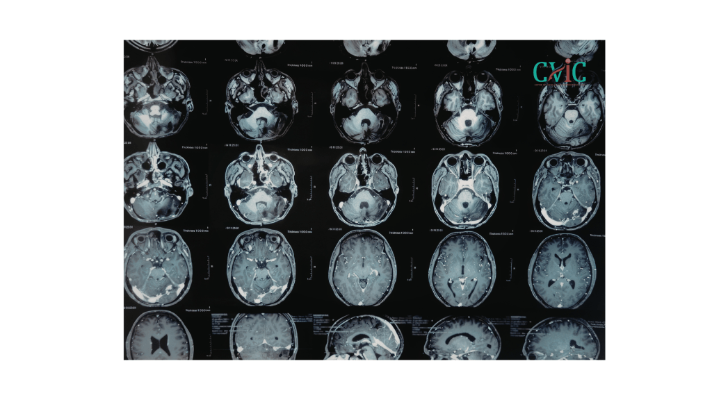 Best neuro interventional radiologist in Indore providing advanced brain and spine vascular treatment at CVIC Indore near Gita Bhawan Indore