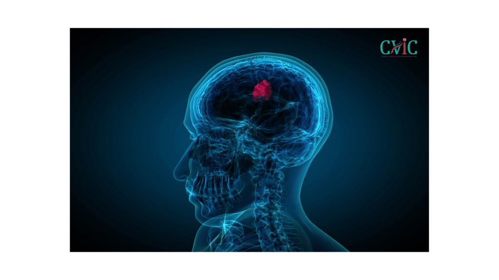 Brain tumor diagnosis and advanced treatment at CVIC Indore by Dr. Alok K Udiya, Dr. Shailesh Gupta, and Dr. Nishant Bhargava near Gita Bhawan Indore