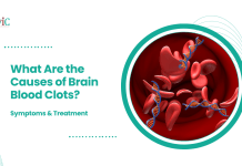 What Are the Causes of Brain Blood Clots? Symptoms & Treatment | CVIC Indore Causes of brain blood clots explained by neurovascular specialists at CVIC Indore near Gita Bhawan Indore