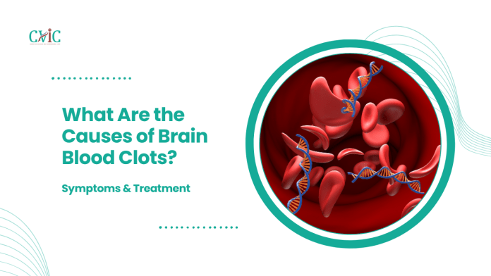 Causes of brain blood clots explained by neurovascular specialists at CVIC Indore near Gita Bhawan Indore