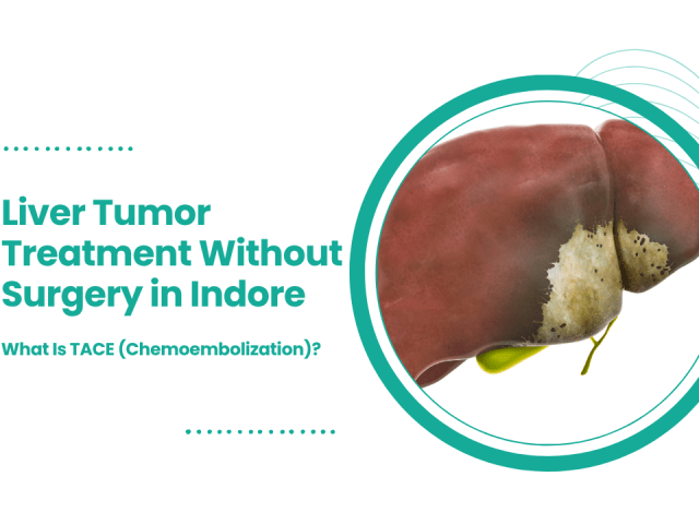Liver Tumor Treatment Without Surgery in Indore: What Is TACE (Chemoembolization)?