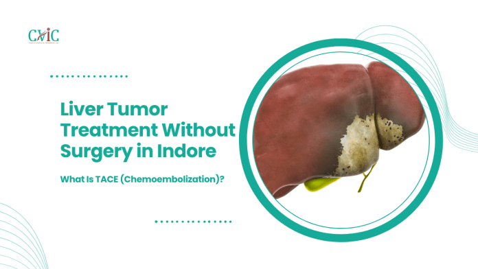 Liver Tumor Treatment Without Surgery in Indore: What Is TACE (Chemoembolization)?