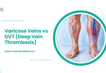 Varicose Veins vs DVT (Deep Vein Thrombosis): How to Tell the Difference Illustration comparing visible varicose veins in one leg with a deep vein blood clot in the other.
