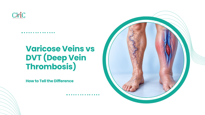 Illustration comparing visible varicose veins in one leg with a deep vein blood clot in the other.