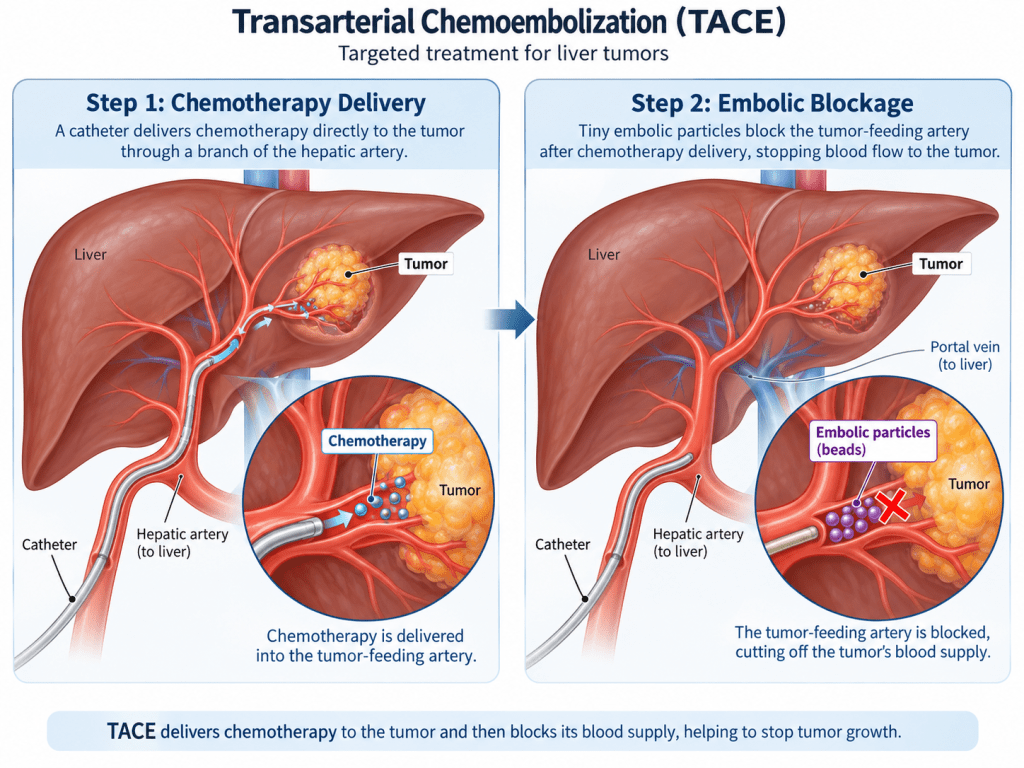 Liver Tumor Treatment Without Surgery in Indore