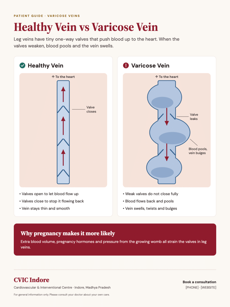Healthy vein vs varicose vein with weak valve
